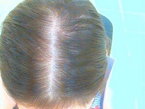 андрогенетическая алопеция